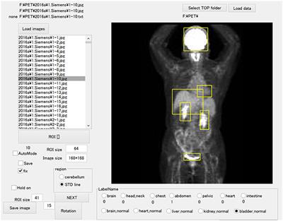 Development of Combination Methods for Detecting Malignant Uptakes Based on Physiological Uptake Detection Using Object Detection With PET-CT MIP Images